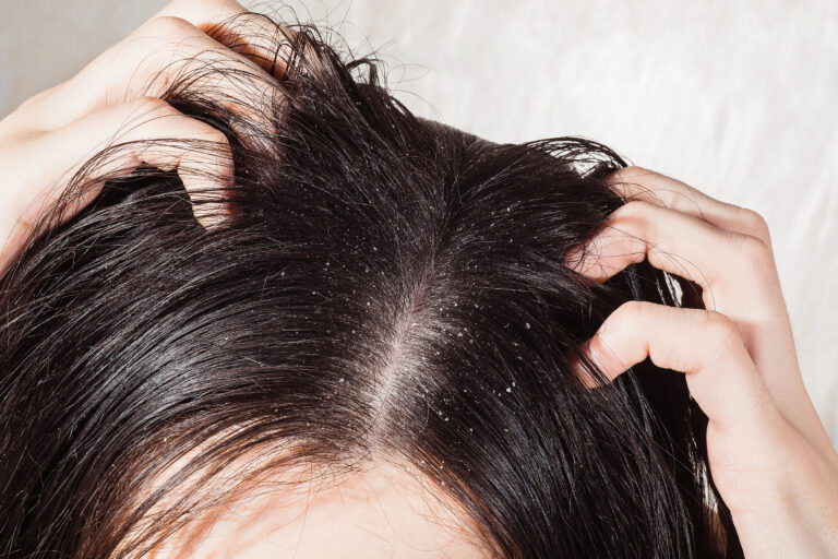 woman scratching her head with dandruff